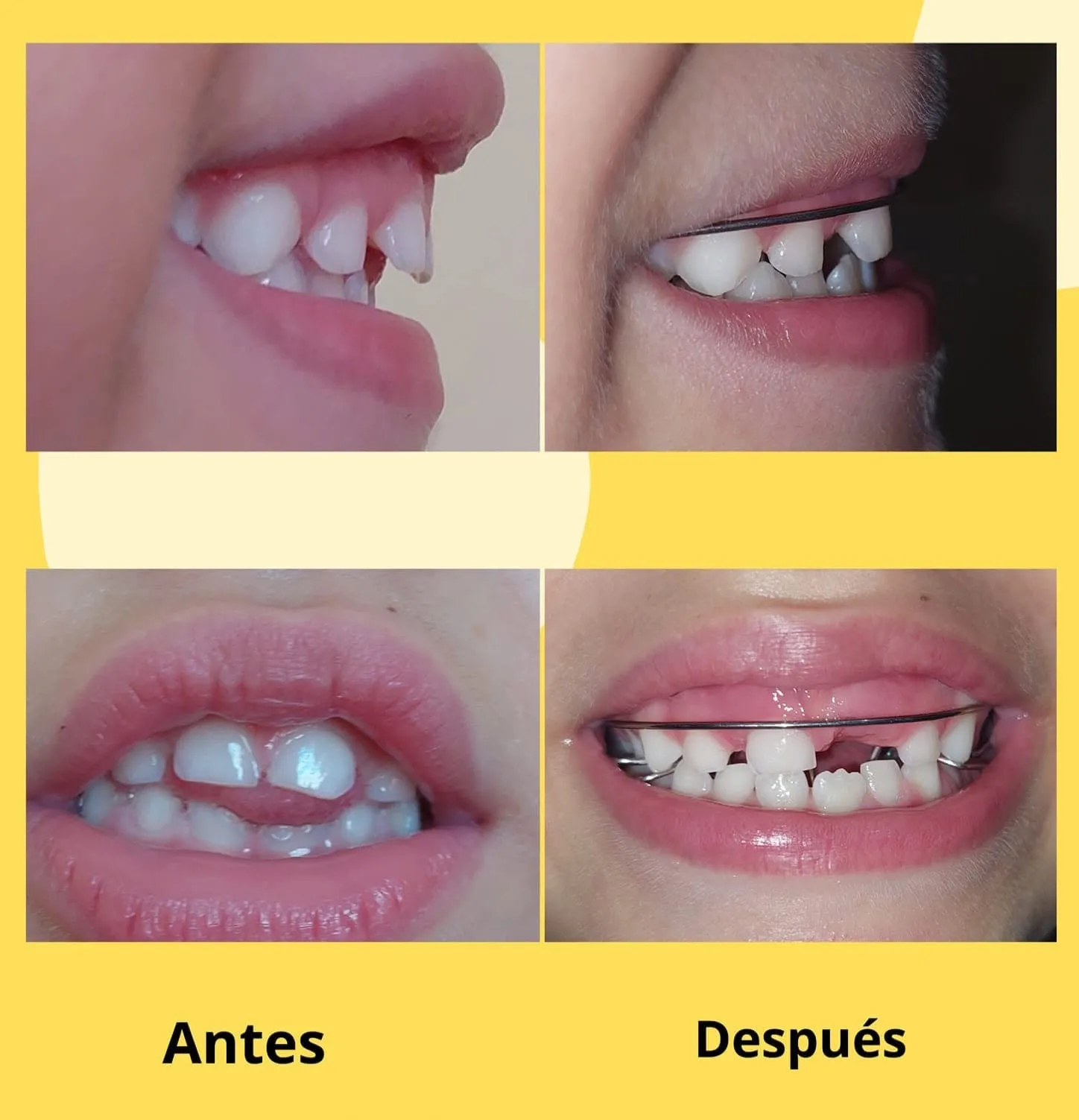 Antes y después: Ortopedia infantil a tiempo