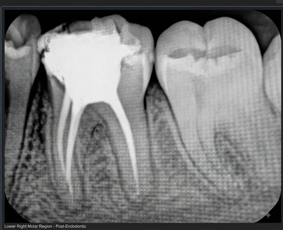 Radiografía: Molar inferior · post-endodoncia