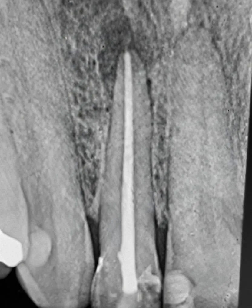 Radiografía: Endodoncia en diente anterior